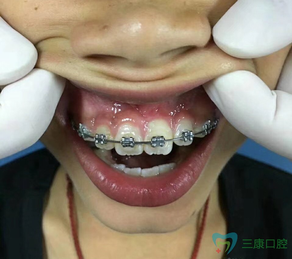 箍牙——8岁小男孩埋伏牙牵引案例