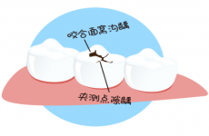 牙齒表面有洞,不疼,該怎麼辦?