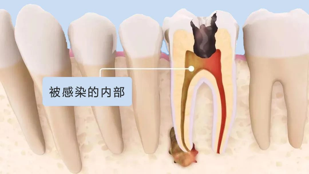 根管治療
