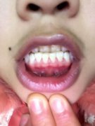 牙齦萎縮能通過洗牙修復嗎?
